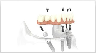 New Teeth Implant Cost NJ